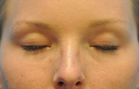 Before-2