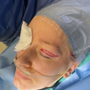 After removal of hooding. Please note precise incision and preservation of muscle fibers without heat trauma to skin and tissue.
