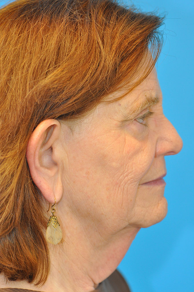 before image