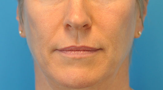 before image