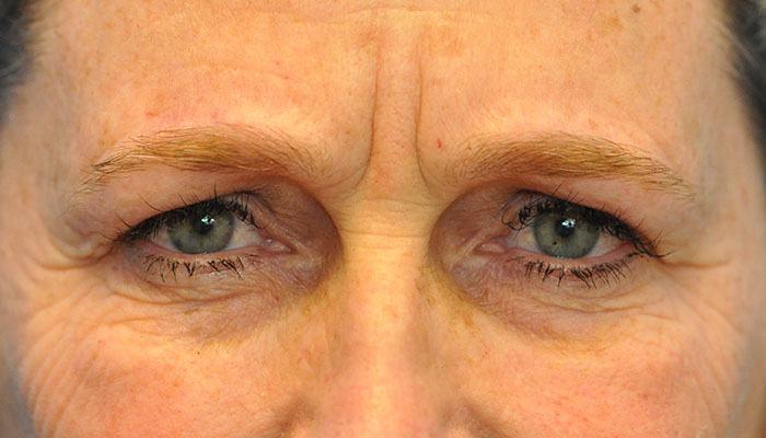 before image
