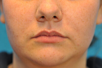 before image