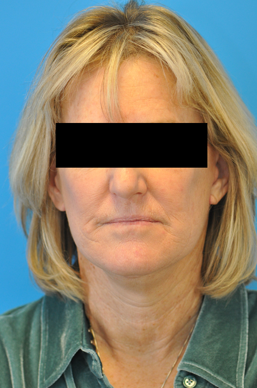 after image