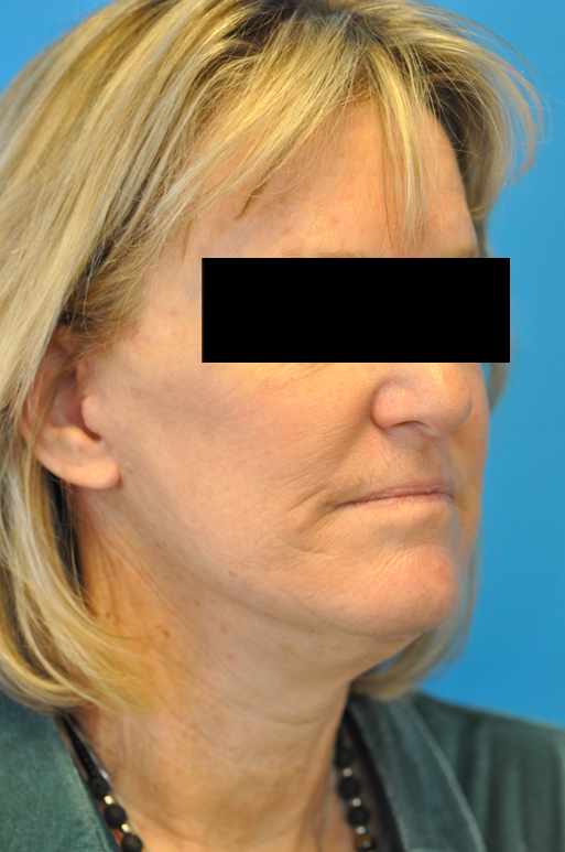 after image