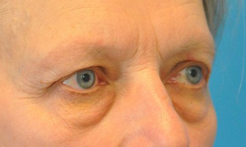 before image