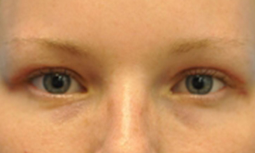 before image