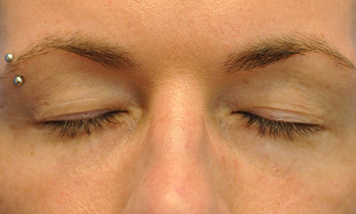 before image