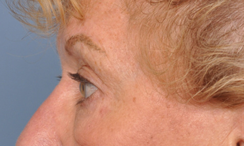 before image