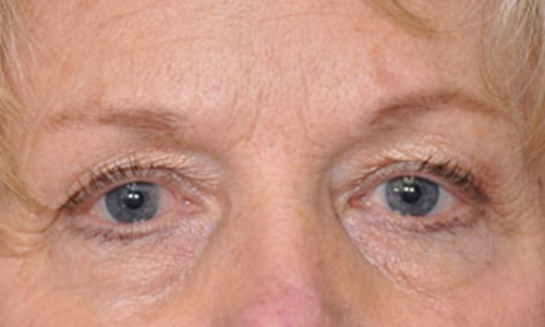 before image