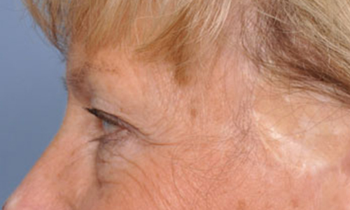 before image
