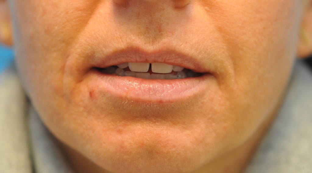 before image