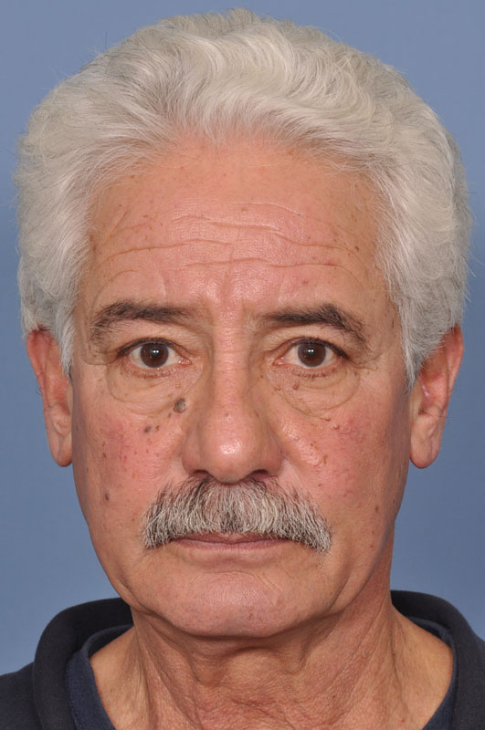 Removal of Facial Moles Patient 1