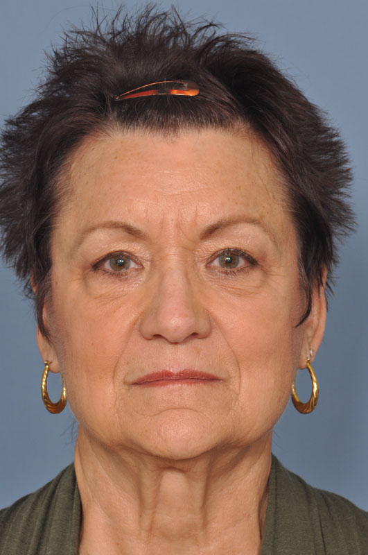 before image
