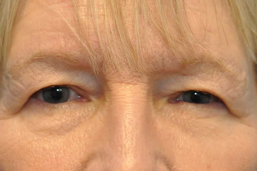 before image